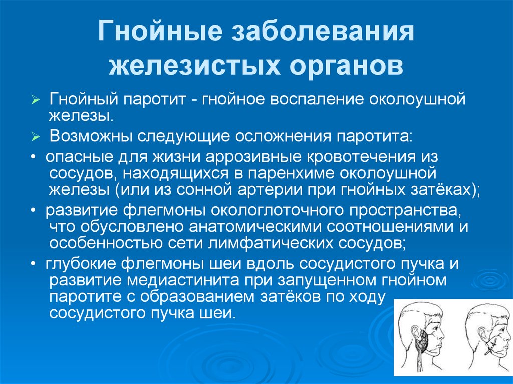 Заболевание желез воспаление. Гнойные заболевания железистых органов. Гнойное воспаление железистых органов. Осложнения эпид паротита. Осложнения при паротите.