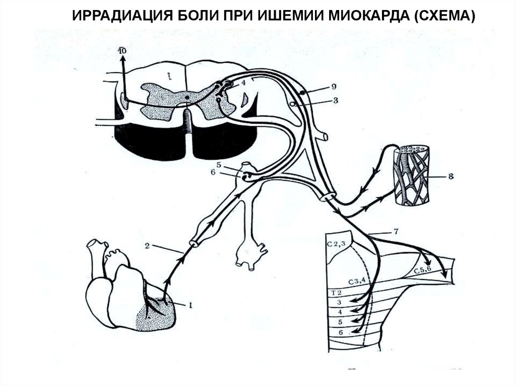 Симптом иррадиации. Патогенез иррадиирующей боли. Механизм иррадиации боли. Иррадиация боли при ишемии.