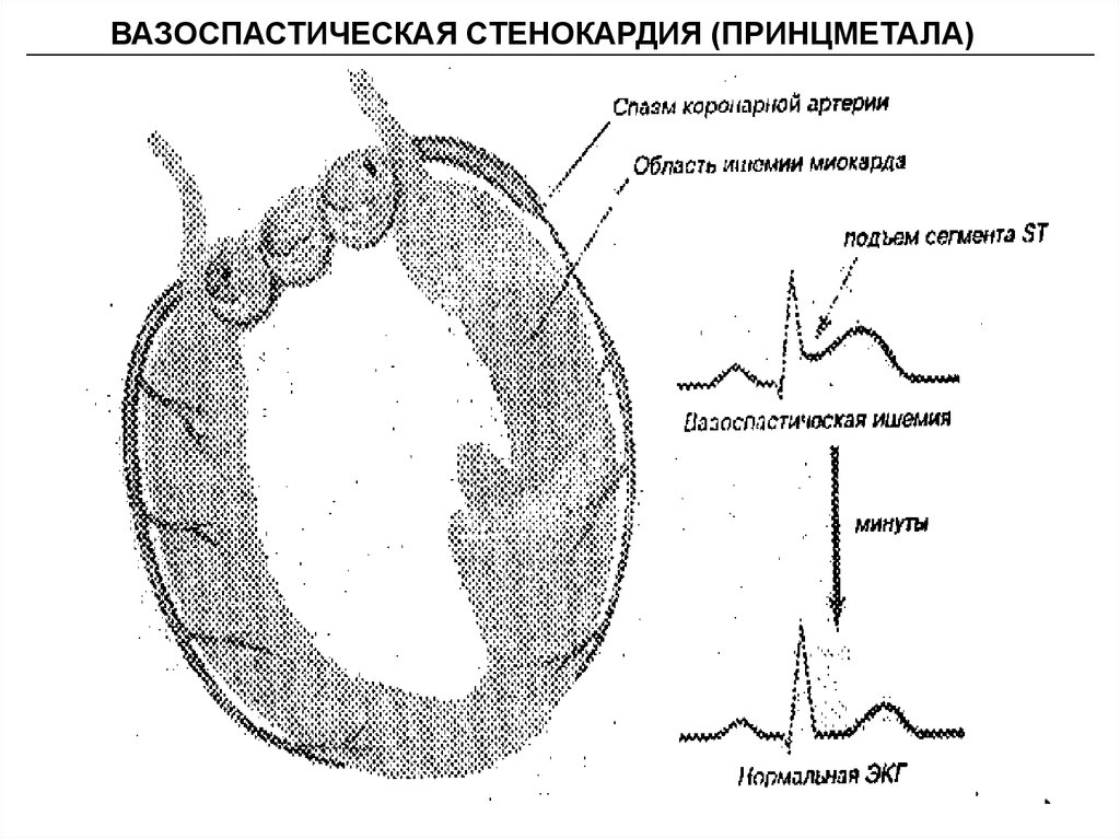 Вариантная стенокардия принцметала. Стенокардия Принцметала патофизиология. Ишемия Принцметала на ЭКГ. ЭКГ при стенокардии Принцметала. ЭКГ при вазоспастической стенокардии.