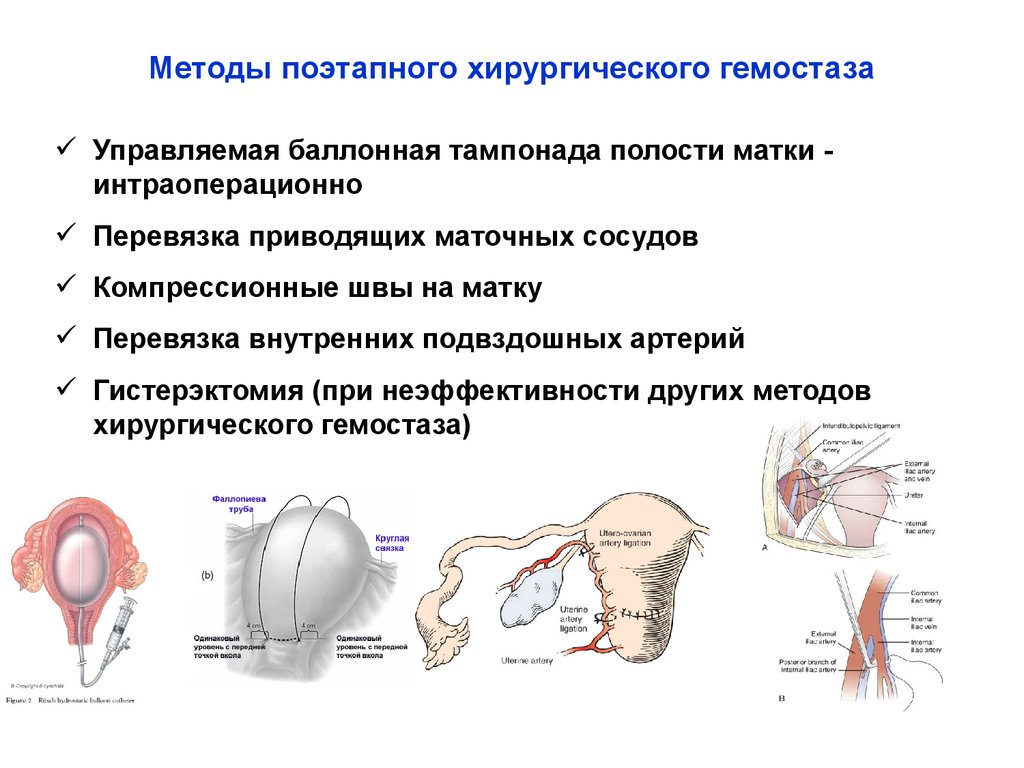 Метод матка. Хирургический метод гемостаза. Управляемая баллонная тампонада. Поэтапный хирургический гемостаз в акушерстве. Управляемая баллонная маточная тампонада.