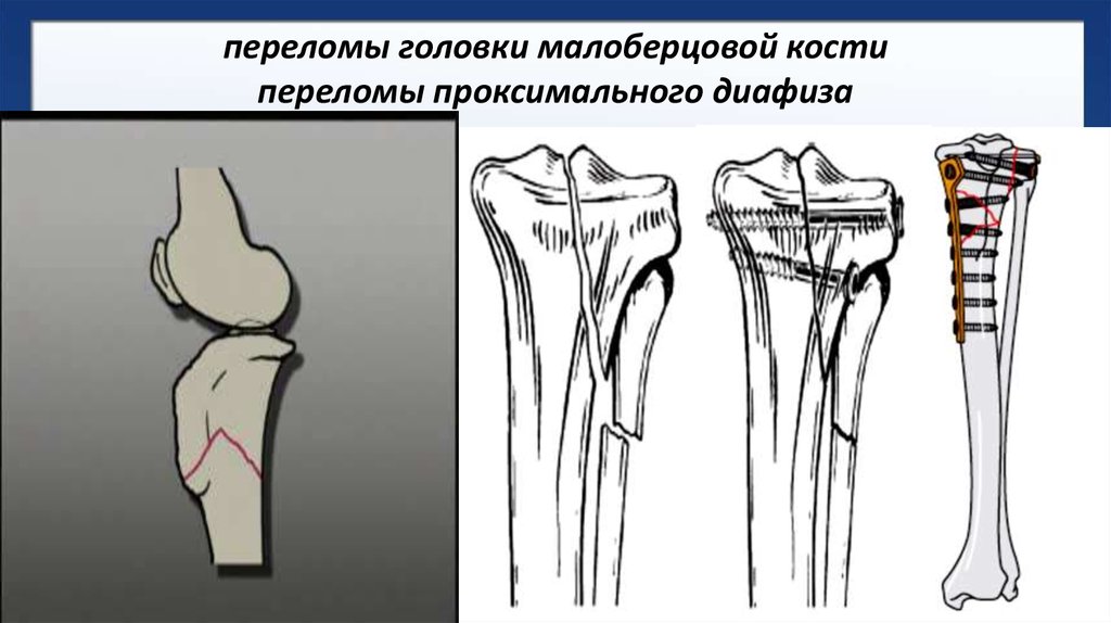 Оскольчатый перелом малоберцовой кости