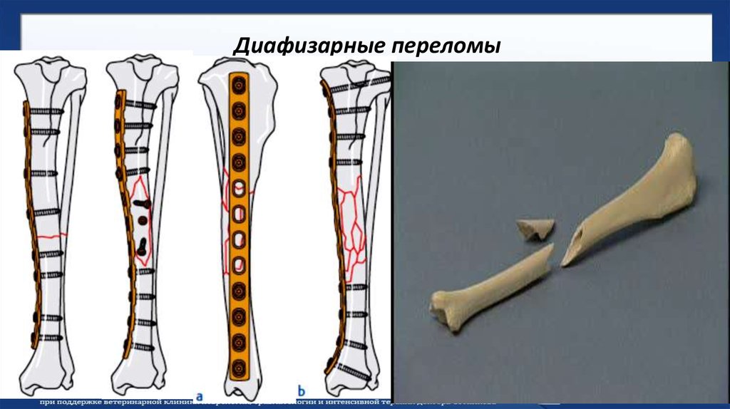 Диафизарные переломы костей голени презентация