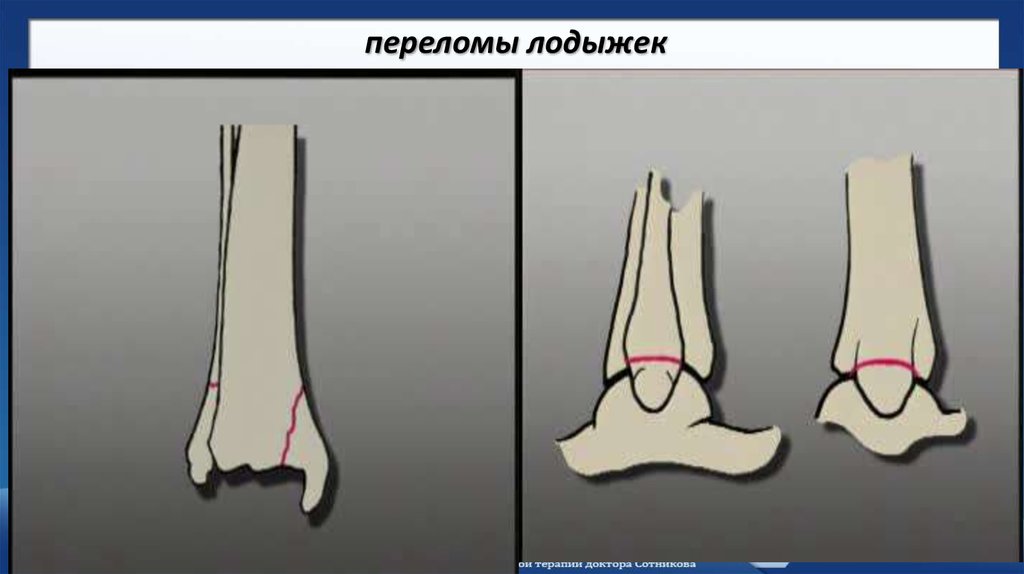 Карта вызова смп перелом голеностопа