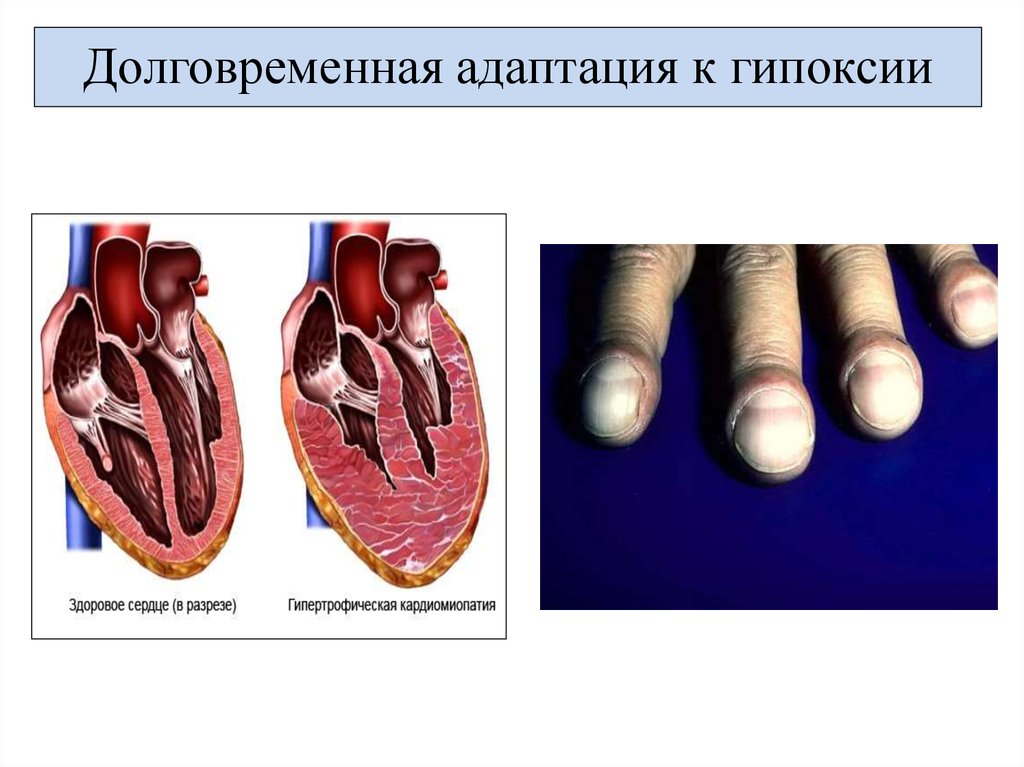 Гипоксия и гипероксия презентация