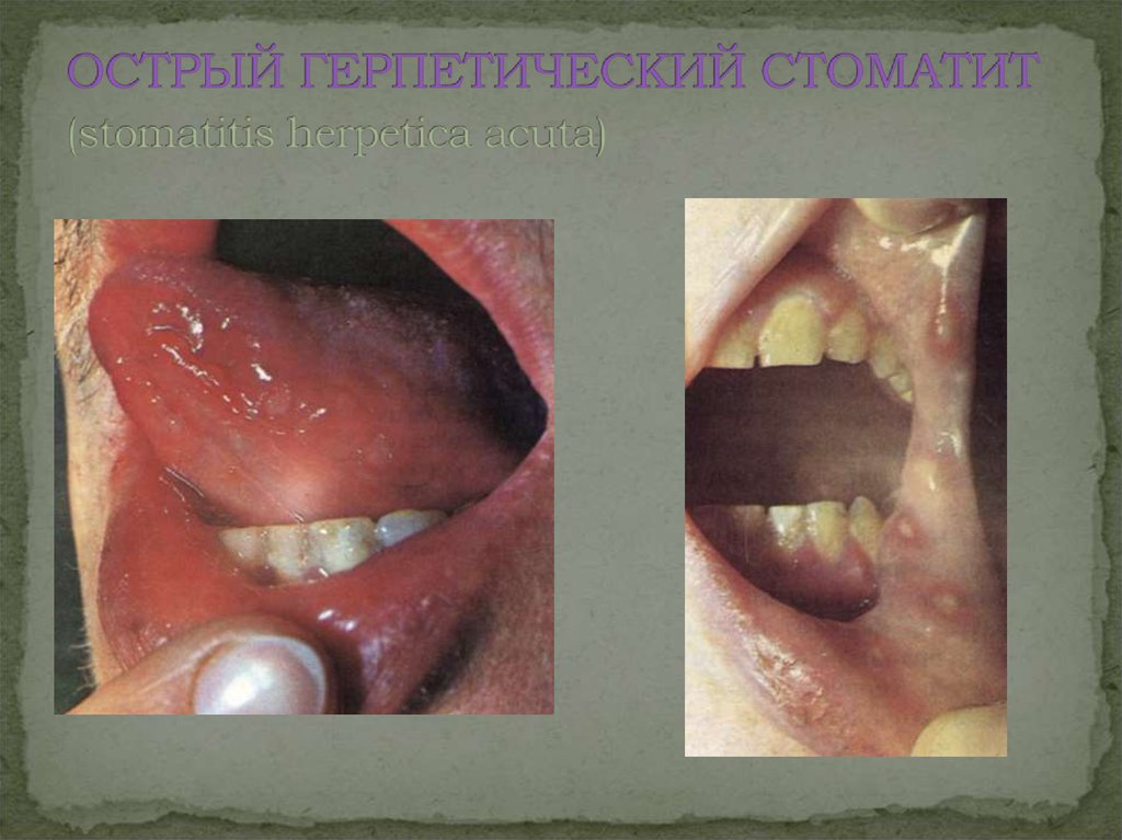 Болезнь боуэна в полости рта фото