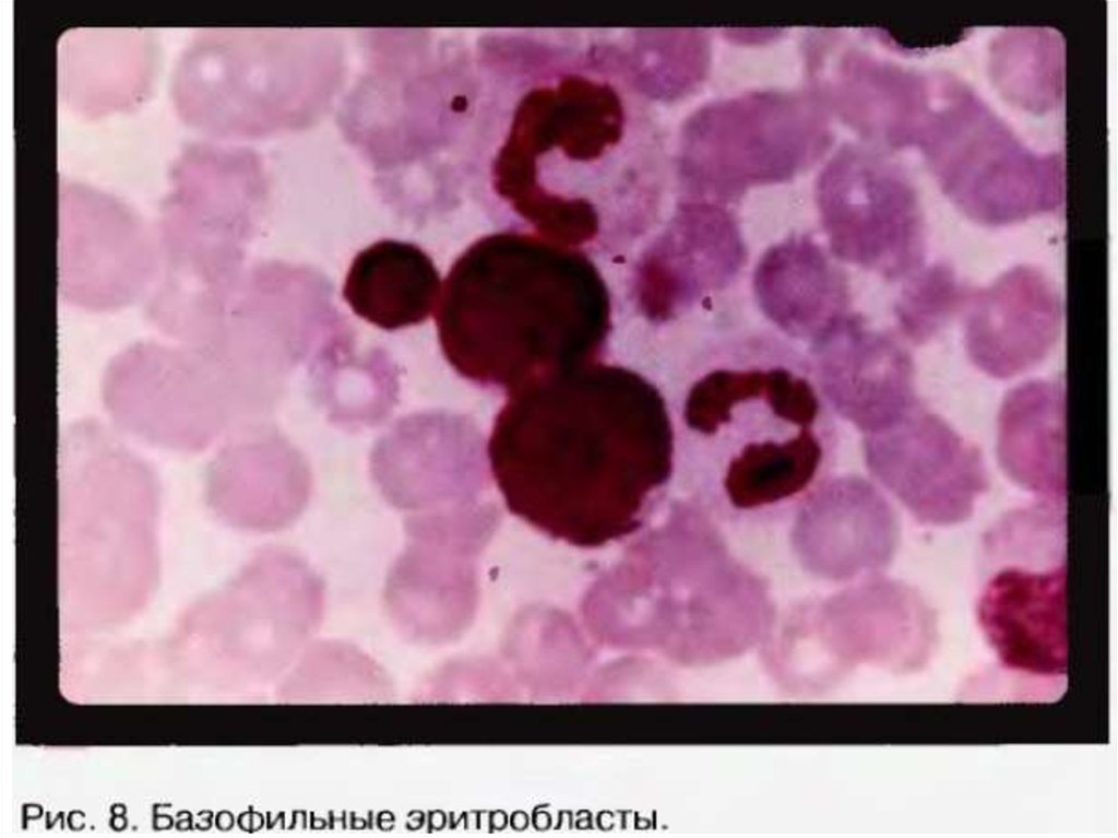 Эритробласт. Оксифильный эритробласт. Базофильный эритробласт. Эритробласт морфология. Полихроматофильный эритробласт