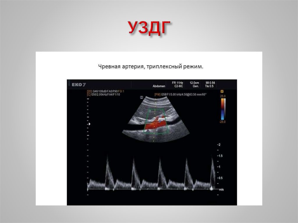 Ультразвуковая допплерография. УЗДГ. Ультразвуковая допплерография (УЗДГ). Допплерография презентация. УЗДГ сосудов шеи и ГМ.