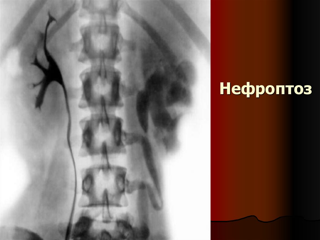 Нефроптоз это. Нефроптоз почки урография. Экскреторная урография нефроптоз. Нефроптоз почек рентген.