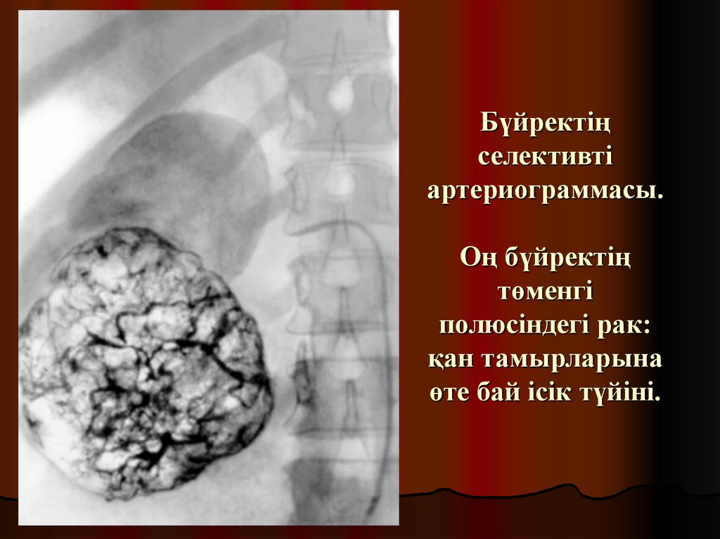 Бүйректің селективті артериограммасы. Оң бүйректің төменгі полюсіндегі рак: қан тамырларына өте бай ісік түйіні.