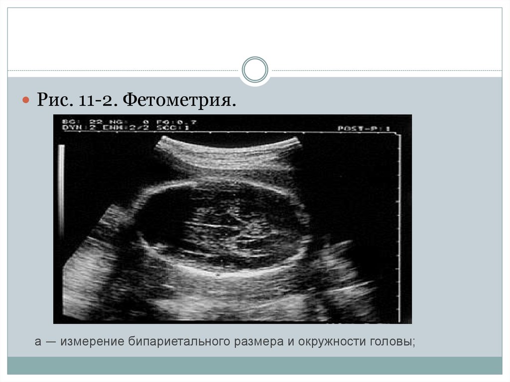 Фетометрия. Ультразвуковая фетометрия. УЗИ скрининг 3 триместра. УЗИ 3 триместр фетометрия. Измерение окружности головы УЗИ.