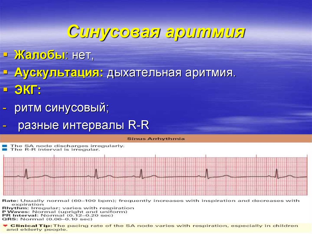 Синусовая аритмия на экг у взрослого. Недыхательная синусовая аритмия на ЭКГ. Дыхательная и недыхательная синусовая аритмия на ЭКГ. ЭКГ при синусовой аритмии. Синусовая дыхательная аритмия на ЭКГ.