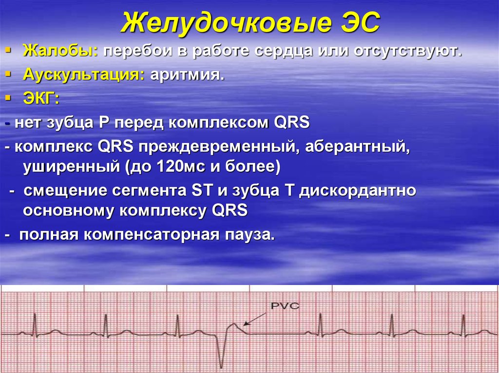 Комплекс экг. Миграция водителя ритма у детей. Желудочковый комплекс QRS. Желудочковый комплекс на ЭКГ. Желудочковый ритм сердца.