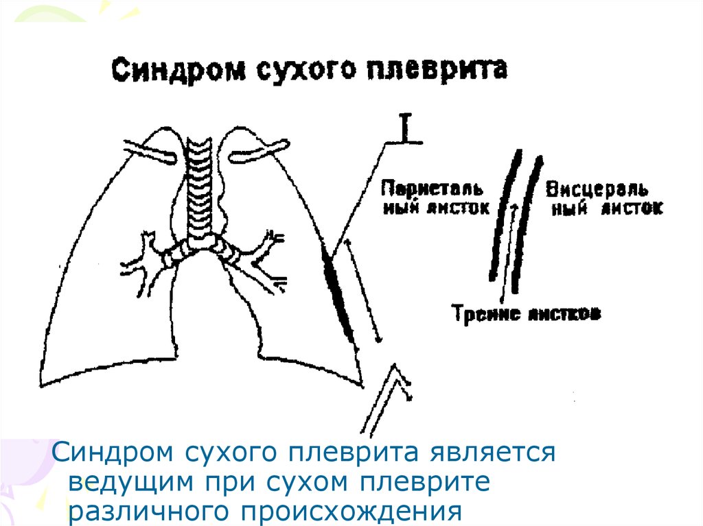 Формы плеврита