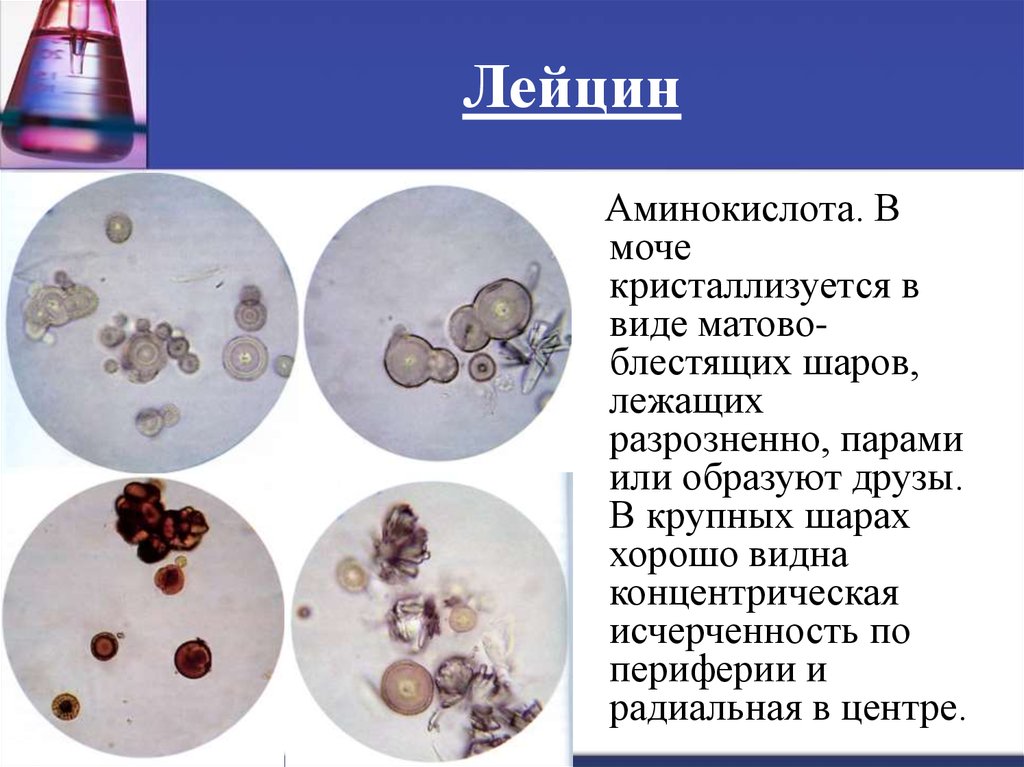 Кристаллы в моче. Кристаллы лейцина в моче. Лейцин в моче микроскопия. Кристаллы тирозина в моче. Кристаллы лейцина и тирозина в моче.