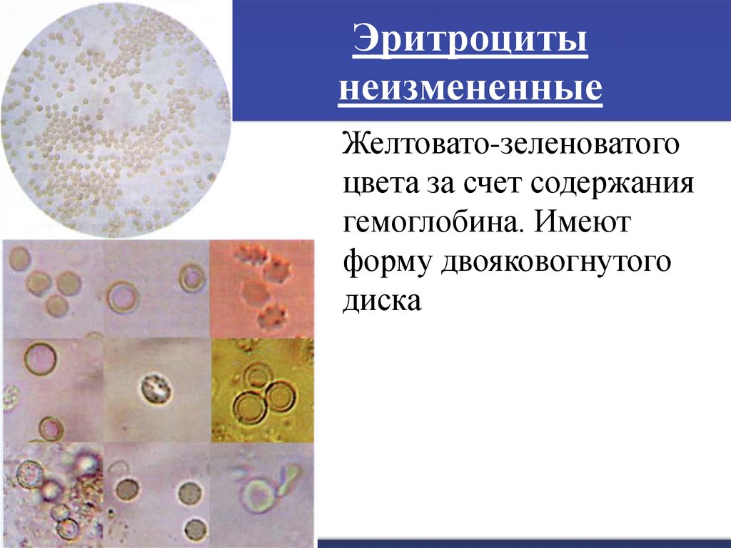 Эритроциты и лейкоциты в моче у мужчин. Измененные и неизмененные эритроциты в моче микроскопия. Измененные эритроциты в моче микроскопия. Эритроциты в моче микроскопия. Измененные и неизмененные эритроциты в микроскопии мочи.
