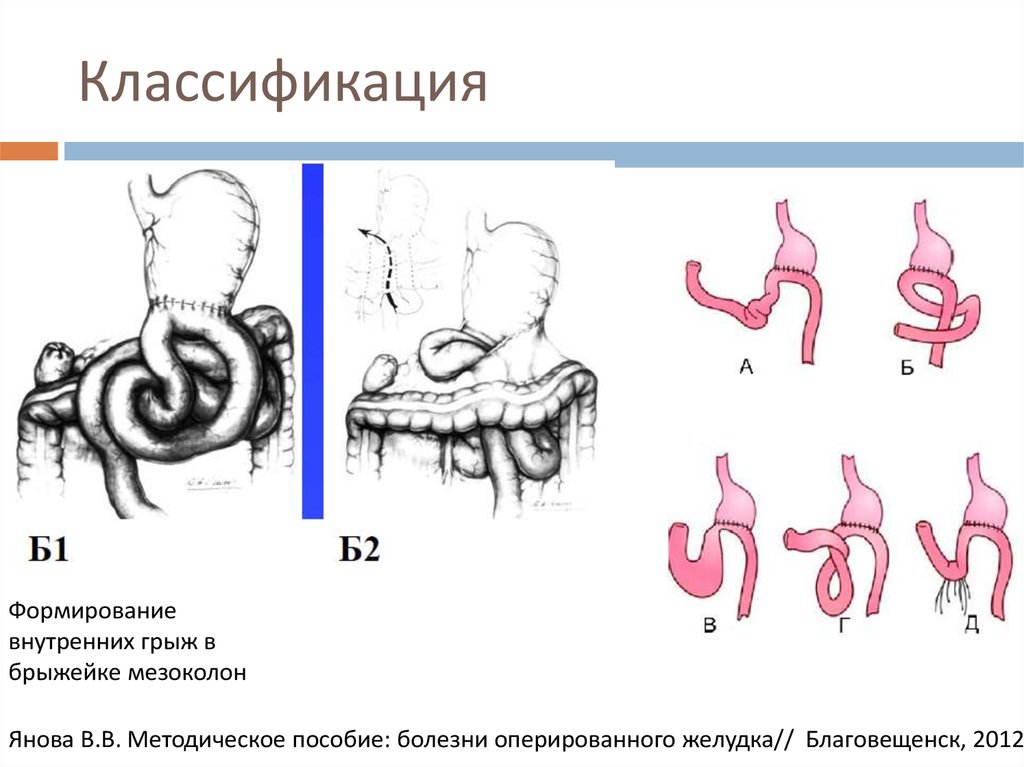 Болезни оперированного желудка презентация
