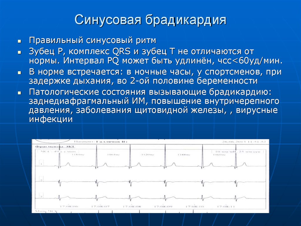 Брадикардия сердца. Брадикардия. Бадигади. Синусовая брадикардия сердца. Синусовый ритм, синусовая брадикардия.