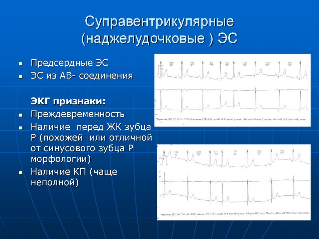 Экг презентация терапия