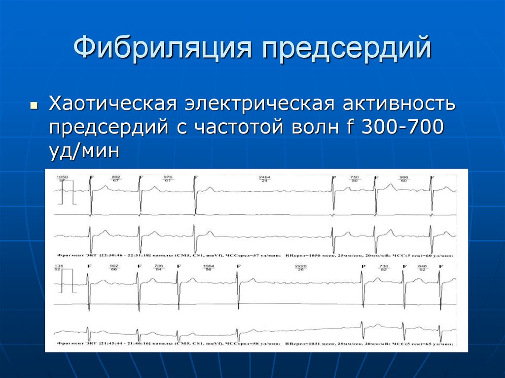 Карта смп фибрилляция предсердий