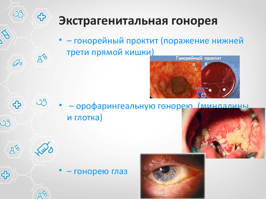 Гонорея картинки для презентации