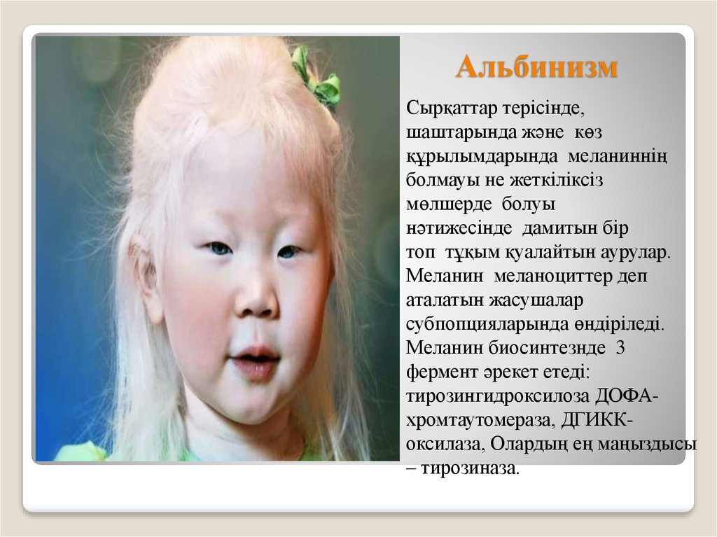 Альбинизмом страдают. Альбинизм. Глазной альбинизм 1 типа.