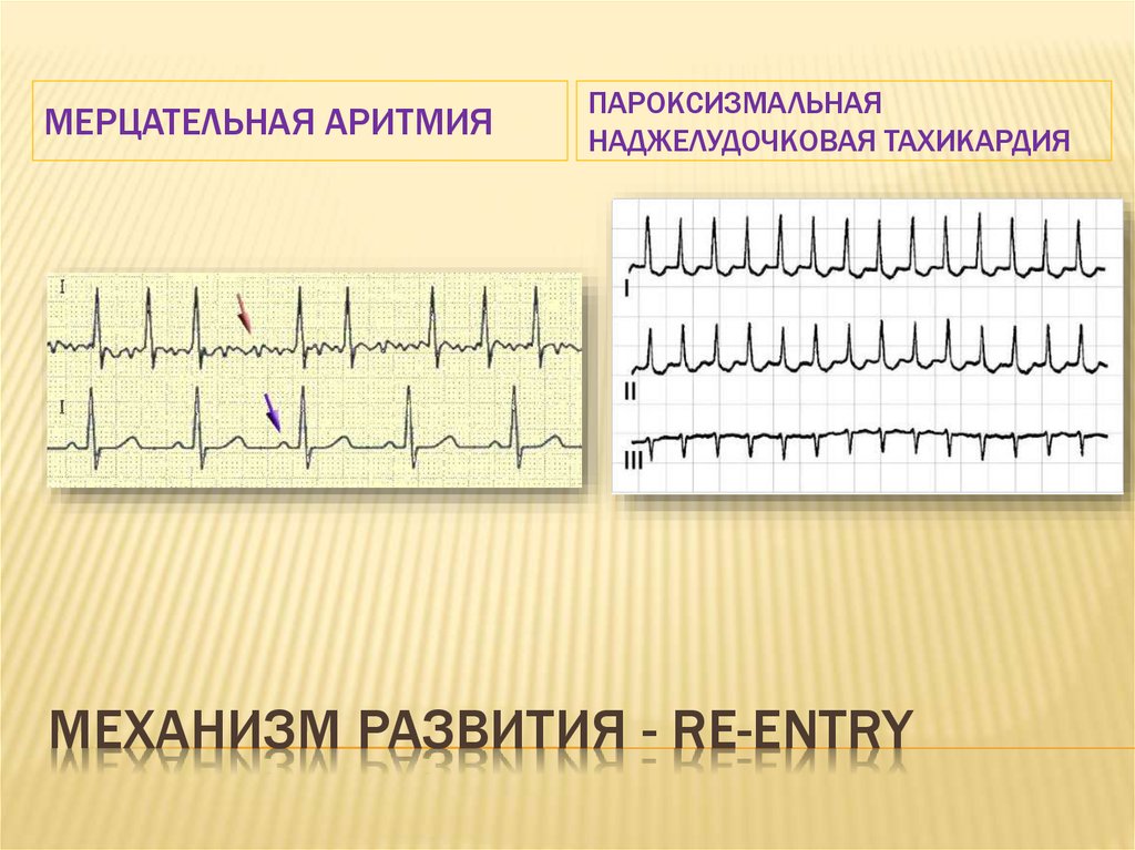 Аритмия и тахикардия. Мерцательная аритмия на ЭКГ пароксизмальная форма. Мерцательная аритмия тахикардия. Пароксизмальная наджелудочковая аритмия ЭКГ. 2. Пароксизмальная Мерцательная аритмия.