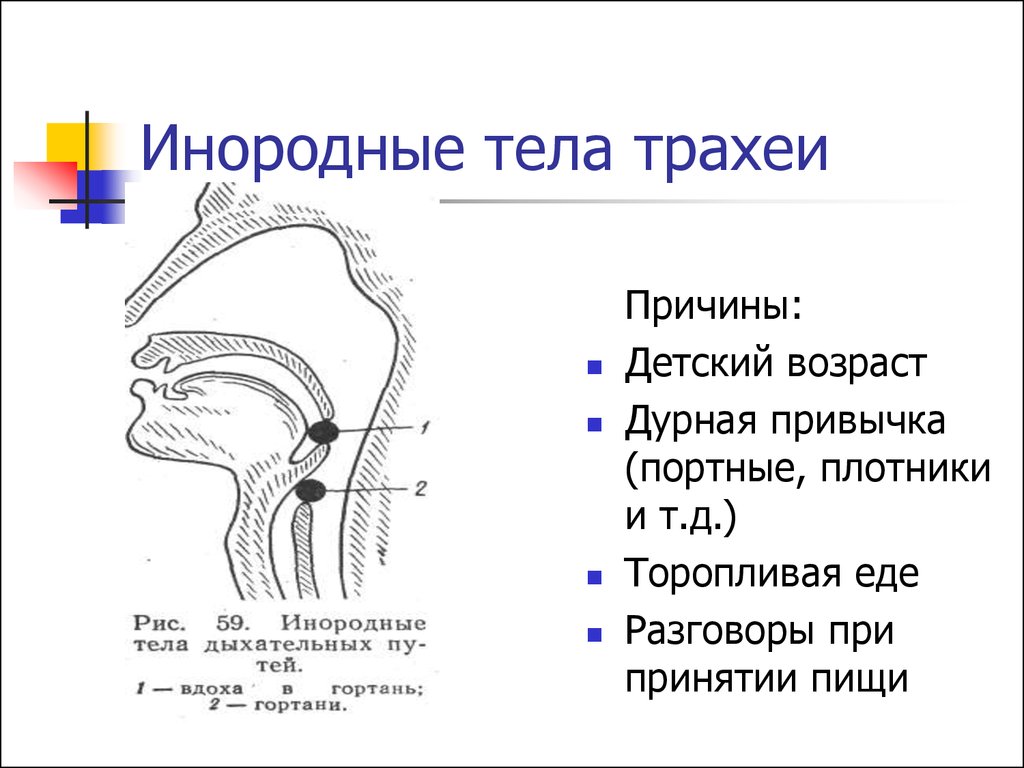 Презентация инородные тела глотки