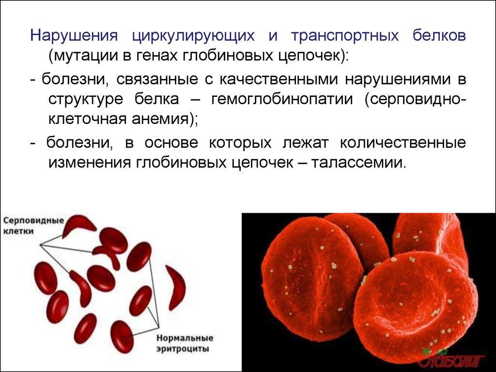 Эритроциты при серповидно клеточной анемии. Патогенез серповидно клеточной анемии. Серповидно-клеточная анемия (s-гемоглобинопатия). Наследственные гемоглобинопатии серповидно клеточная анемия. Серповидноклеточная анемия мутация.