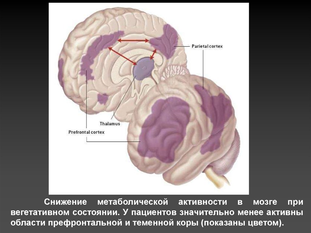 Вегетативное состояние. Вегетативная состояние мозга. Метаболическая активность мозга это. Хроническое вегетативное состояние смерть мозга. Снижение метаболической активности.