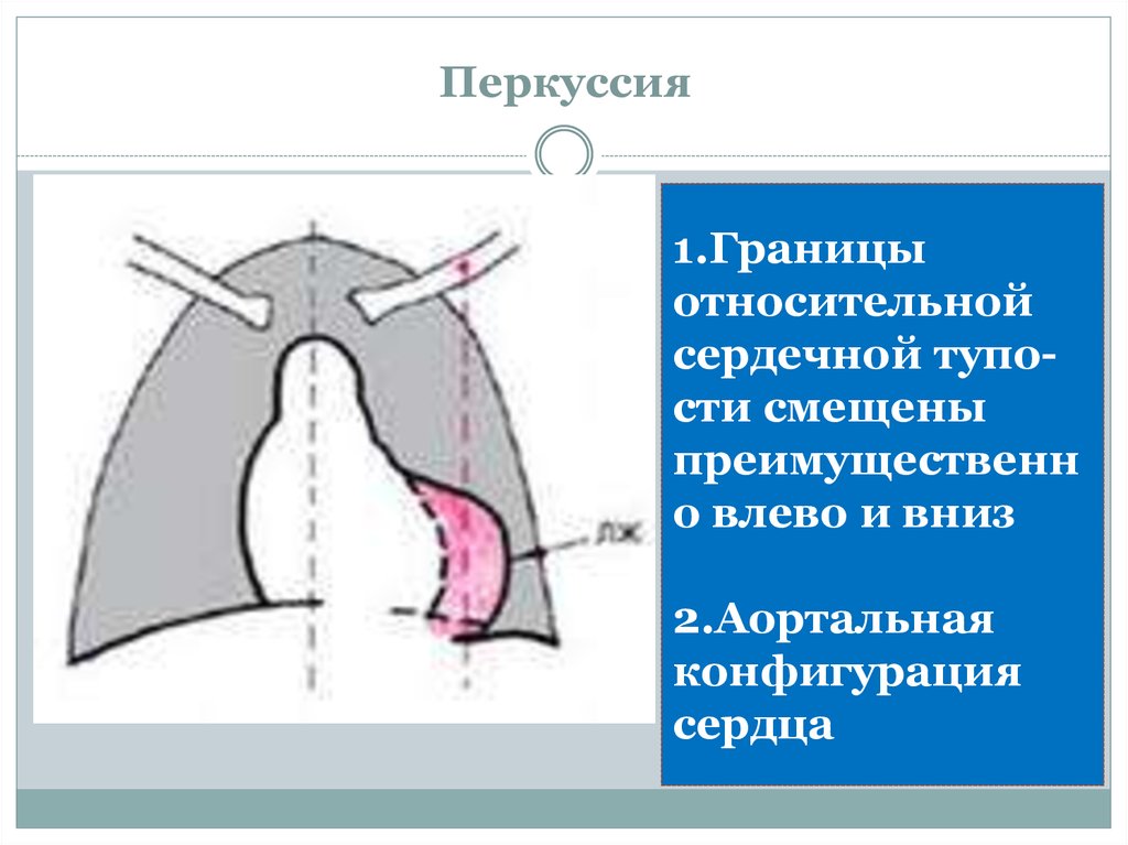 Конфигурация сердца аортальная схема