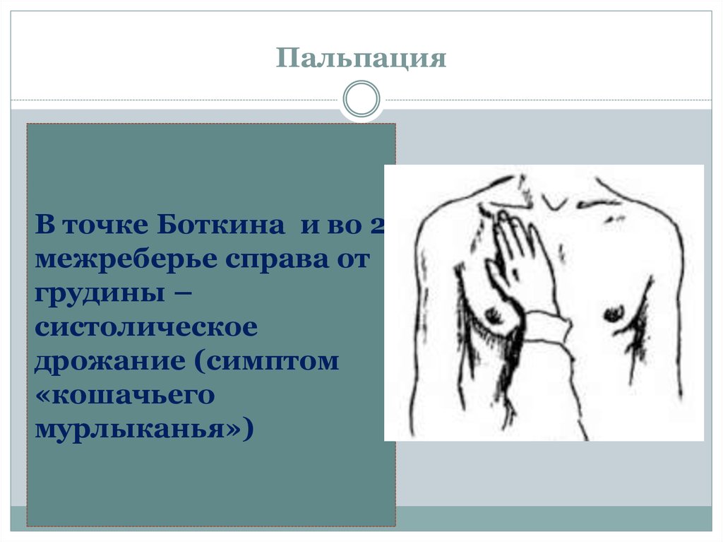 Пальпация сердца. Систолическое дрожание во 2 межреберье. Симптом кошачьего мурлыканья пропедевтика. Систолическое дрожание грудной клетки. Симптом систолического дрожания.