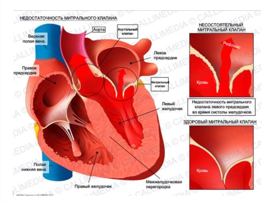 Сердечная недостаточность митрального клапана. Недостаточность двустворчатого (митрального) клапана. Пороки сердца митральная недостаточность. Порок митрального клапана сердца.
