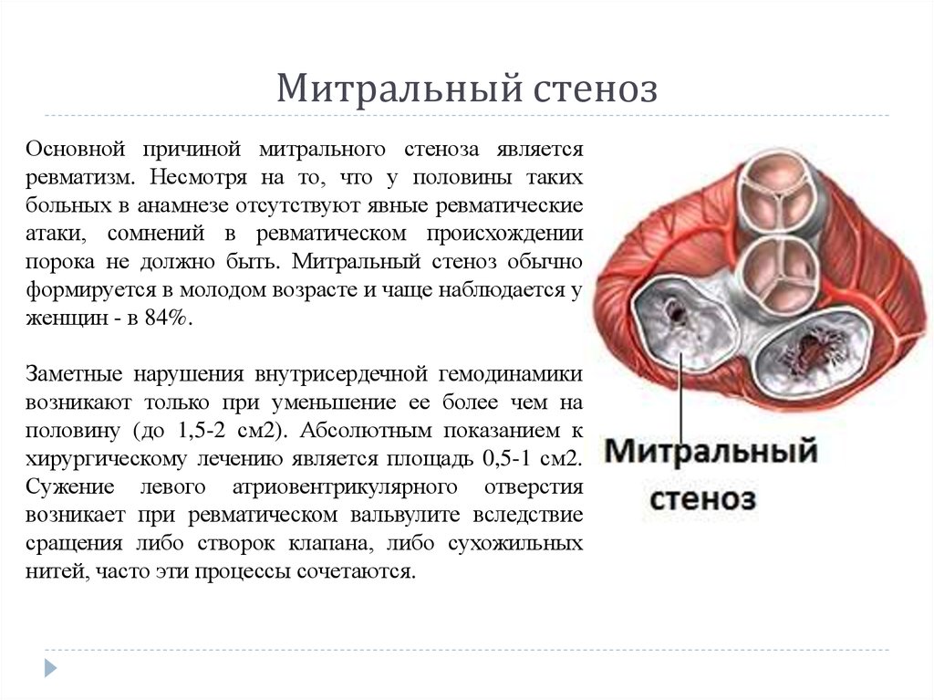 Приобретенные пороки сердца факультетская терапия презентация