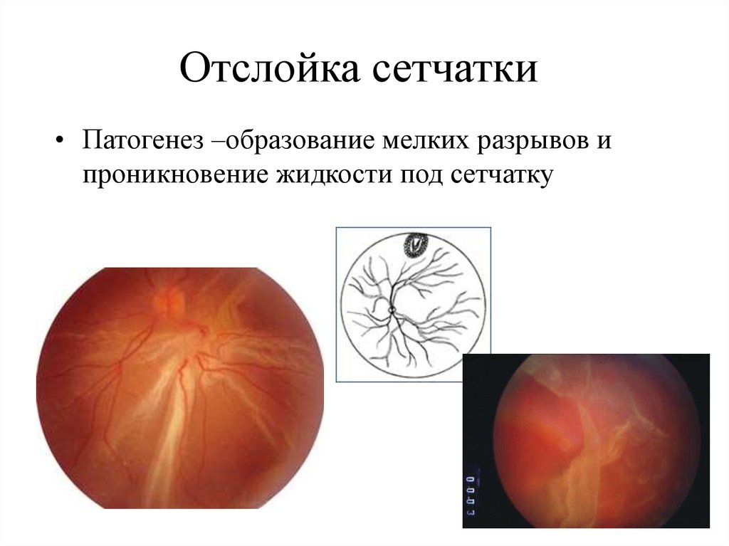 Отслойка сетчатки презентация