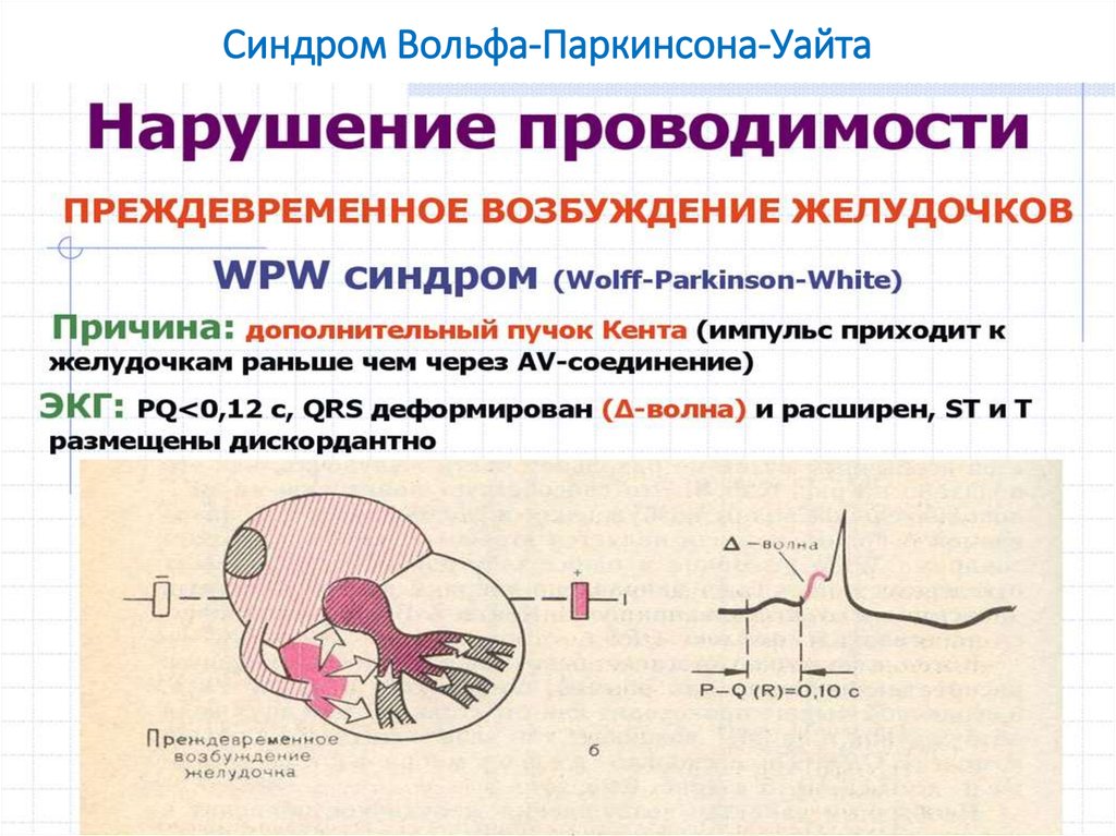 Синдром вольфа хиршхорна фото