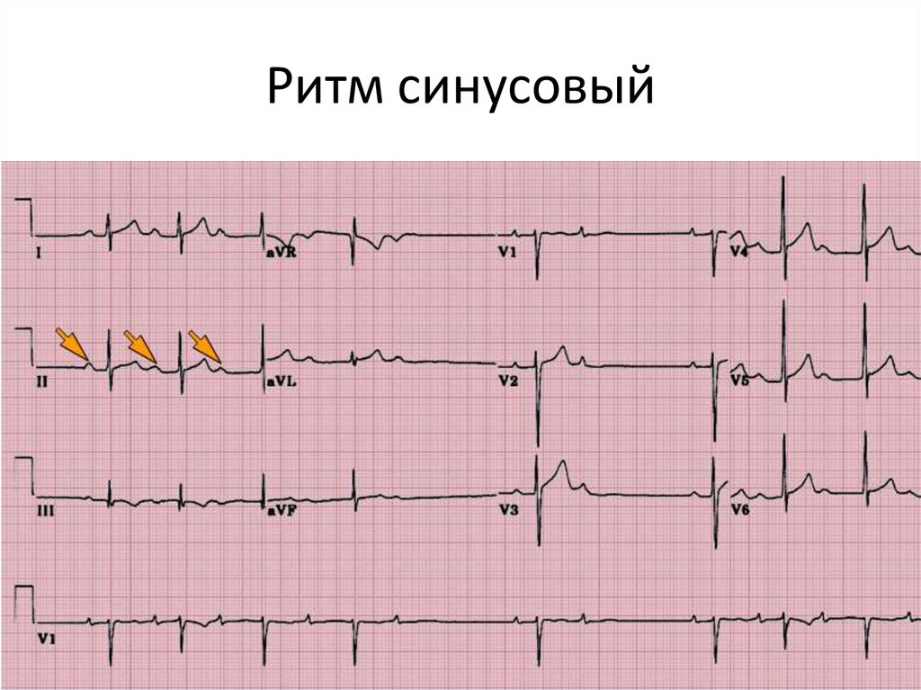 Что значит синусовый ритм сердца на экг. Кардиограмма сердца синусовый ритм норма. Кардиограмма сердца расшифровка синусовый ритм норма. ЭКГ нормальные синусовый ритм норма. Правильный синусовый ритм на ЭКГ.
