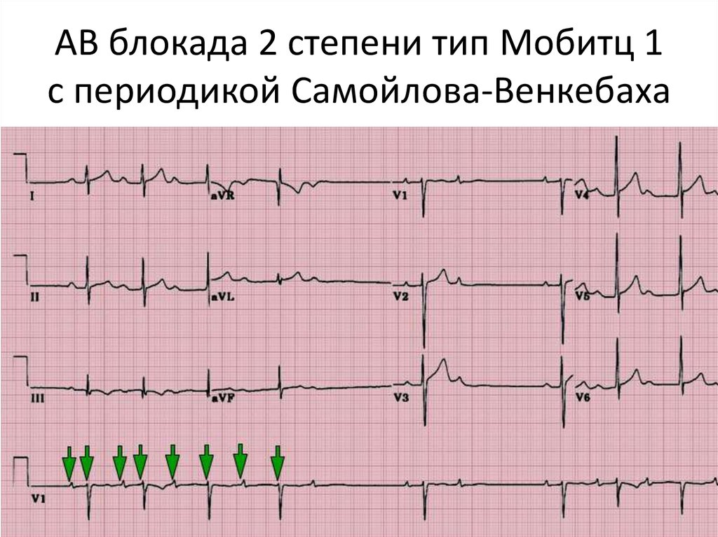 Ав блокада 1 степени. Атриовентрикулярная блокада Мобитц 1 на ЭКГ. Атриовентрикулярная блокада 2 степени Мобитц 2 на ЭКГ. АВ блокада 2 ст Мобитц 1 на ЭКГ. АВ-блокады II степени: Мобитц 2 ЭКГ.