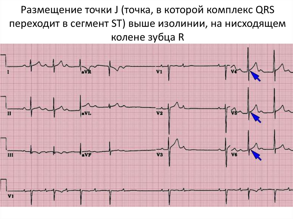 Компьютерное заключение синусовый ритм что это