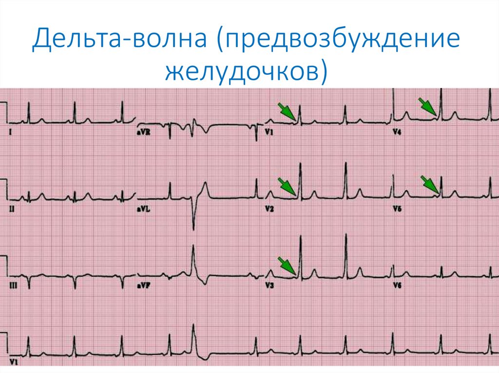 На экг обнаружили