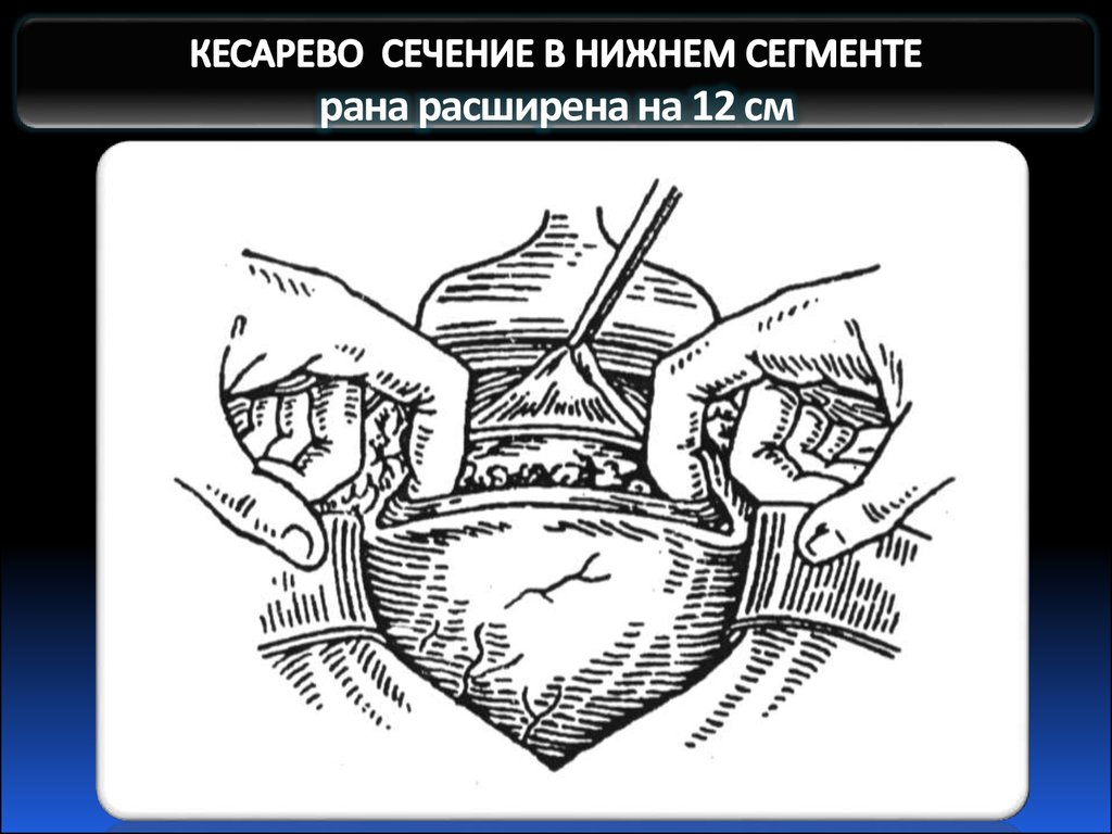 КЕСАРЕВО СЕЧЕНИЕ В НИЖНЕМ СЕГМЕНТЕ рана расширена на 12 см 