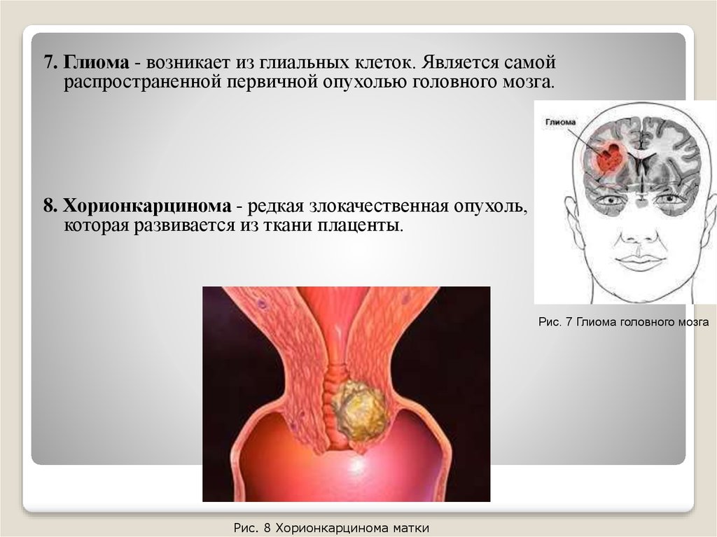 Сестринский уход при опухолях головного мозга презентация