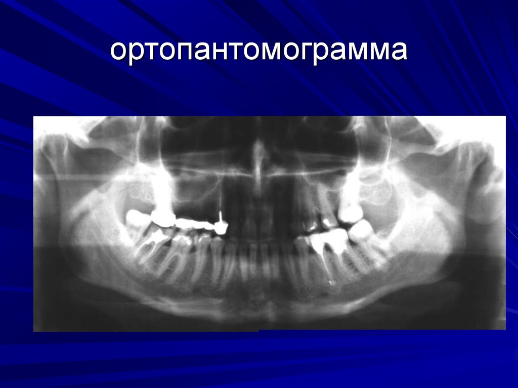 Схема описания ортопантомограммы