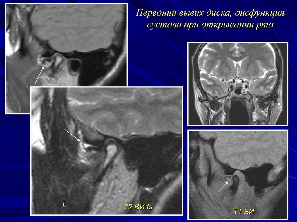 Мрт височно нижнечелюстного сустава. Вывих височно нижнечелюстного сустава мрт. Передний вправляемый вывих диска ВНЧС мрт. Подвывих височно-нижнечелюстного сустава мрт. Передняя дислокация диска ВНЧС.