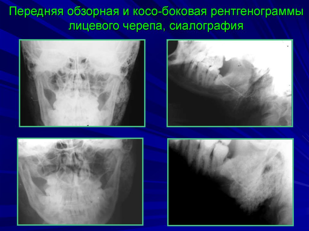 Сиалография слюнных