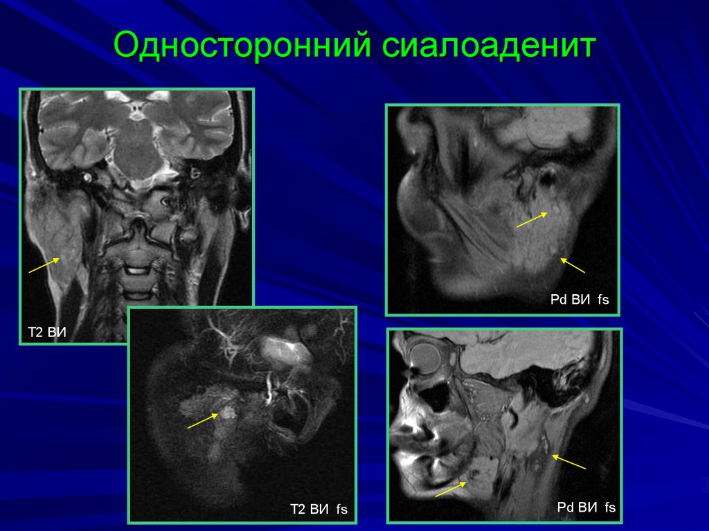 Сиалоаденит на узи фото