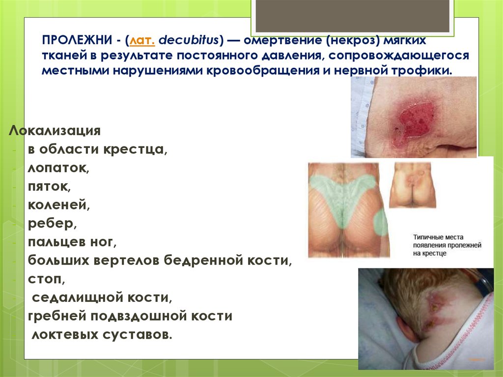 ПРОЛЕЖНИ - (лат. decubitus) — омертвение (некроз) мягких тканей в результате постоянного давления, сопровождающегося местными