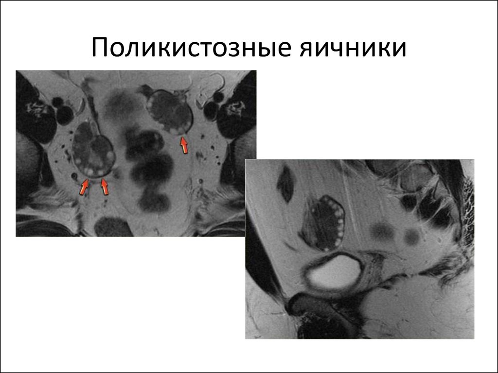 Поликистозные яичники. Мультифолликулярные яичники мрт. Поликистоз яичников мрт. Мультикистоз яичников мрт. Синдром поликистозных яичников диагноз.