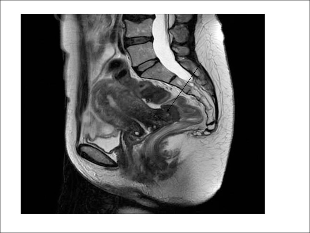 Образование в малом тазу у женщин. Субмукозная миома матки мрт.