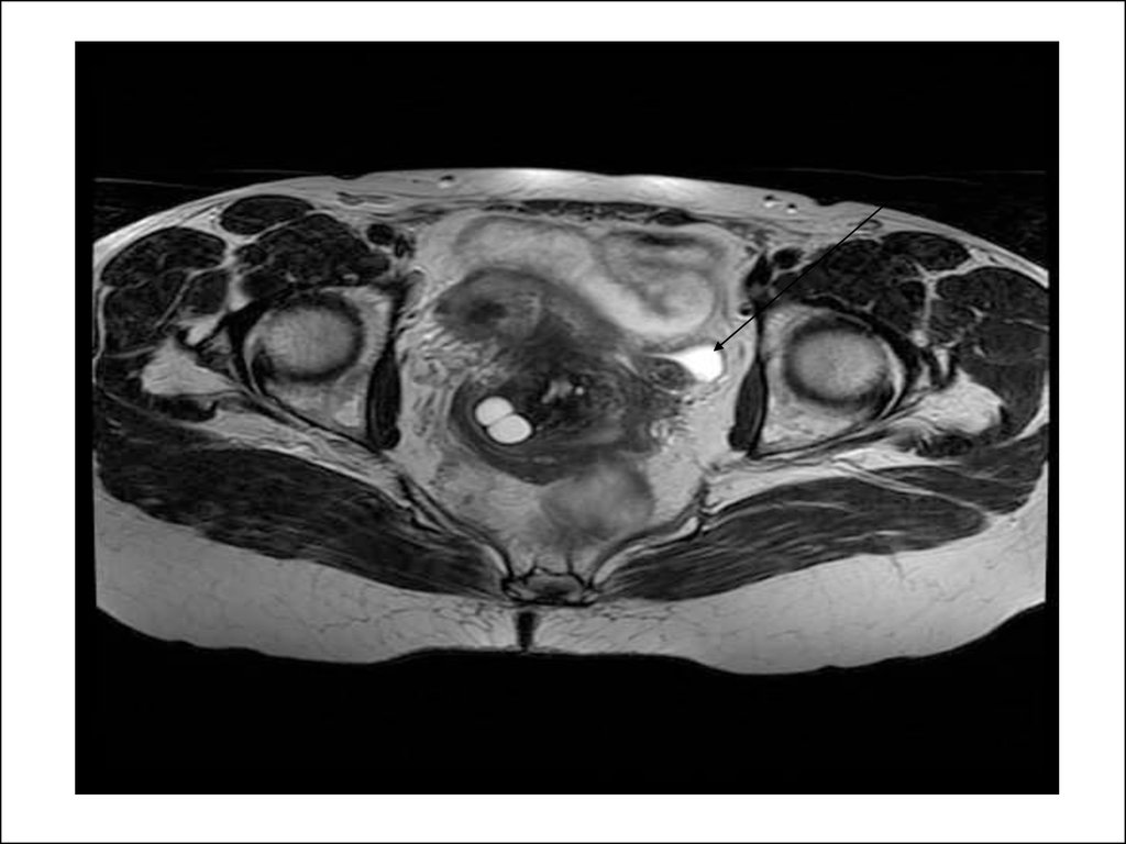 Мрт матки. Серома малого таза мрт. Миома матки на мрт малого таза.