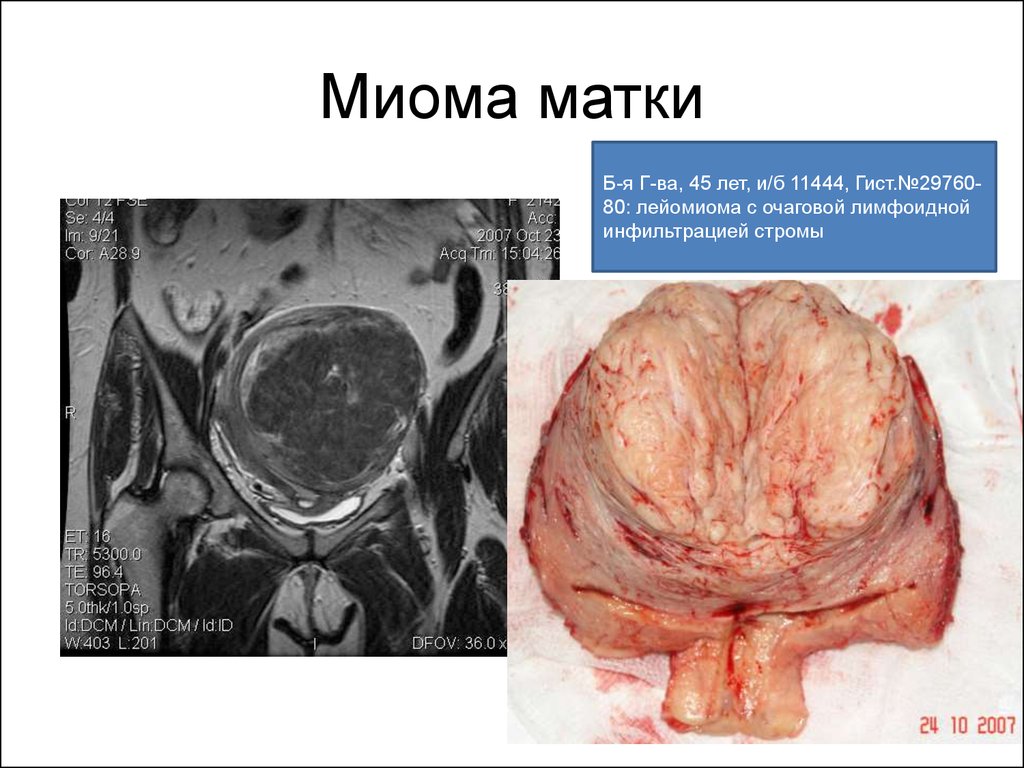 Выпавшая матка у женщины фото